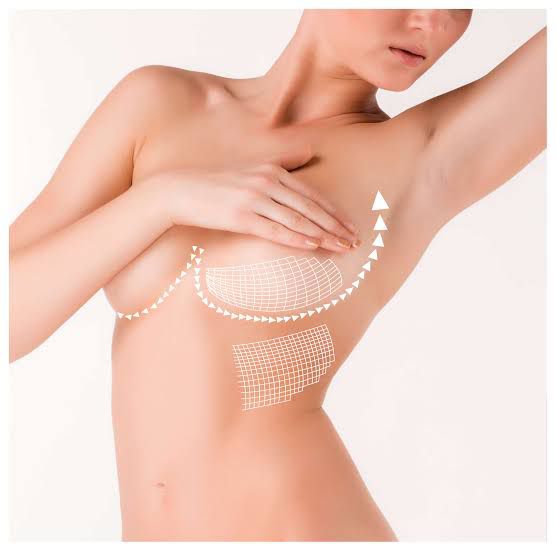 PDO Threads Breast Lift